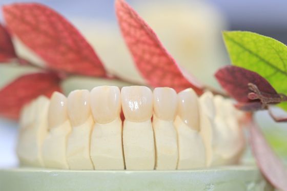 Zahnmedizinischer Laborörtlich festgelegter Prosthetics überlagerte Zirkoniumdioxid-zahnmedizinische Krone für Front Teeth