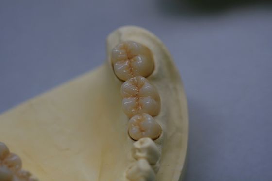 Zahnmedizinisches Laborzirkonium-Oxid-Porzellan-Zirkoniumdioxid-zahnmedizinische Krone mit keramischem