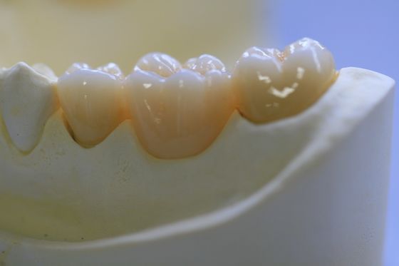 Zahnmedizinischer Laborörtlich festgelegter Prosthetics überlagerte Zirkoniumdioxid-zahnmedizinische Krone für Front Teeth
