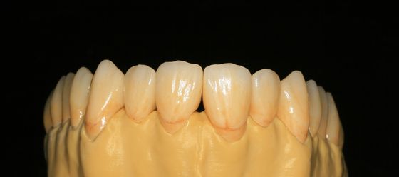 Zahnmedizinischer Laborörtlich festgelegter Prosthetics überlagerte Zirkoniumdioxid-zahnmedizinische Krone für Front Teeth