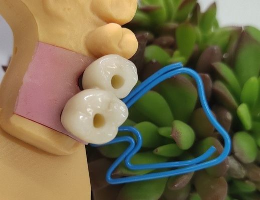 Zahnimplantate Endosseous krönen
