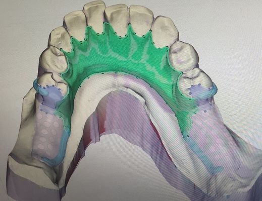 Entfernbares 3D druckte Teilprothese-Metallrahmen