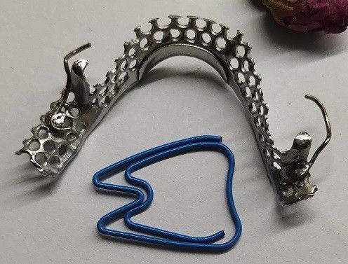 Casted-Mandibularbogen-Teilprothese-Metallrahmen