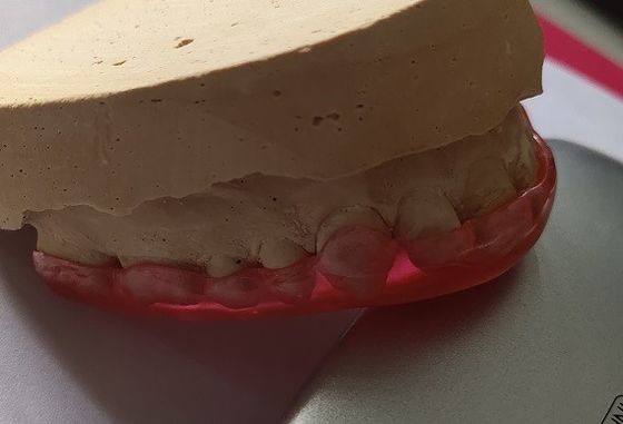 Harter maxillarer Bogen-Stabilisierungs-acrylsauerschutz For Bruxism