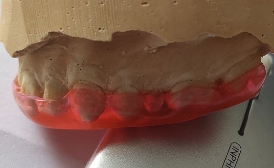 Michigan-Schutz Trushine Bite Plane für das Zahn-Reiben