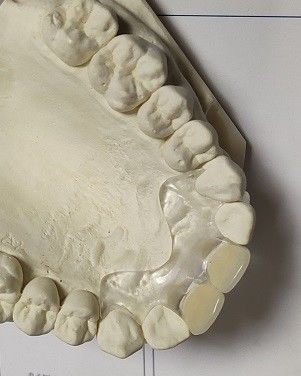 Bequemes weiches unsichtbares Gebiss des Sitz-ISO13485 RPD