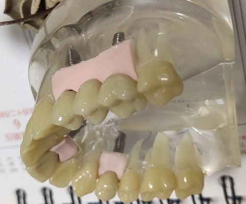 100 provisorische Krone Prozent Biocompatibility PMMA
