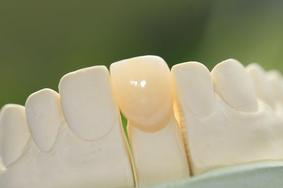 Natürliches dauerhaftes Glas-keramische zahnmedizinische Krone für Frontzähne