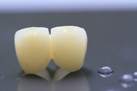 Laborkrone des Druck-3D zahnmedizinische des Rahmen-PFM für Zahnheilkunde