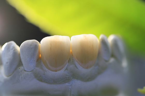 Laborkrone des Druck-3D zahnmedizinische des Rahmen-PFM für Zahnheilkunde